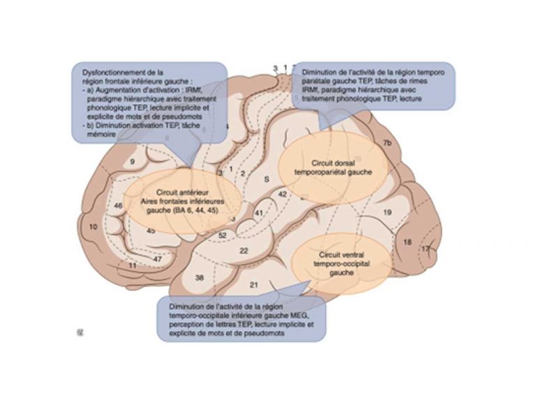 Neuroanatomie de la dyslexie